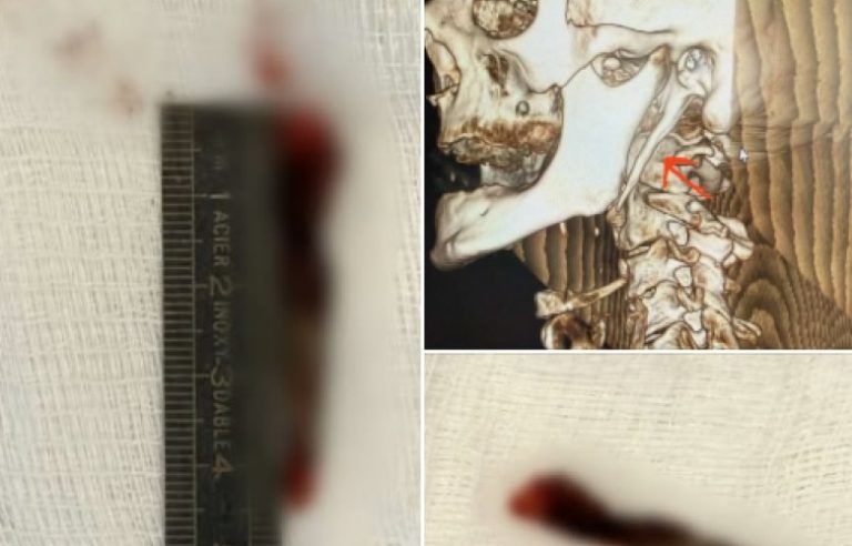Realizohet me sukses ndërhyrja e parë kirurgjikale për Sindromën Eagle në QKUK